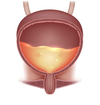 Cystectomy by OrangeCountySurgeons